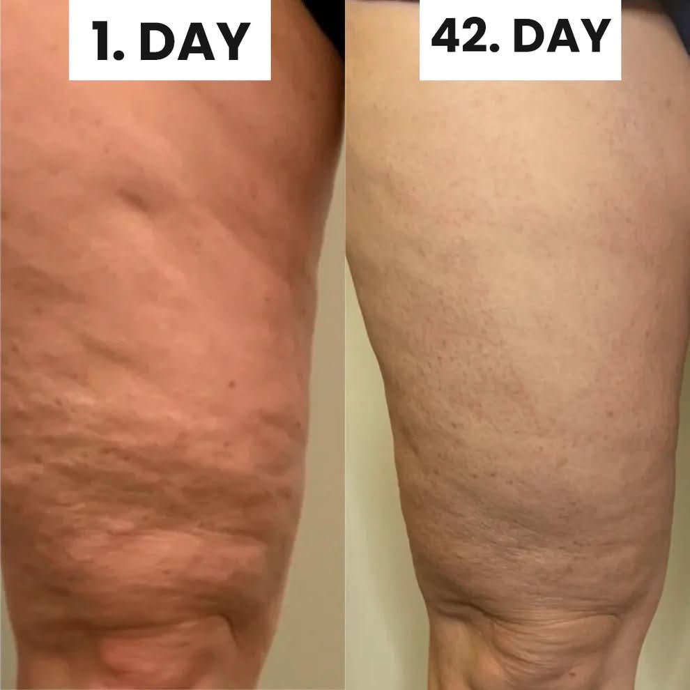 Cellulite Relief Kit