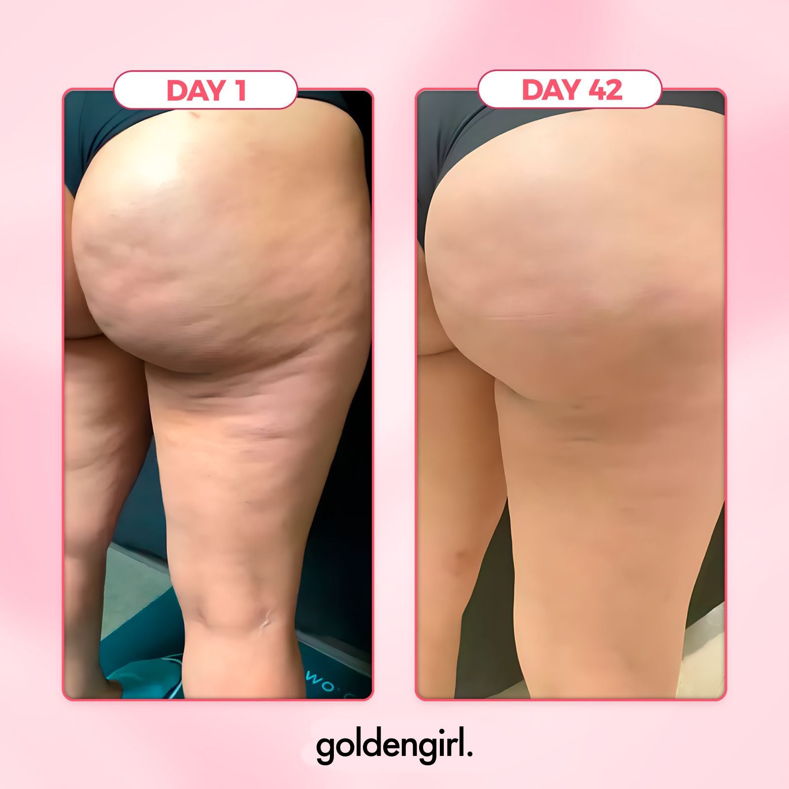 Cellulite Relief Kit